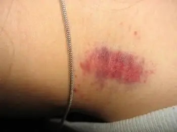 quèsignifica hickey al coll