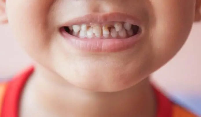 Perché un bambino ha i denti neri: possibili cause, modi per risolvere il problema