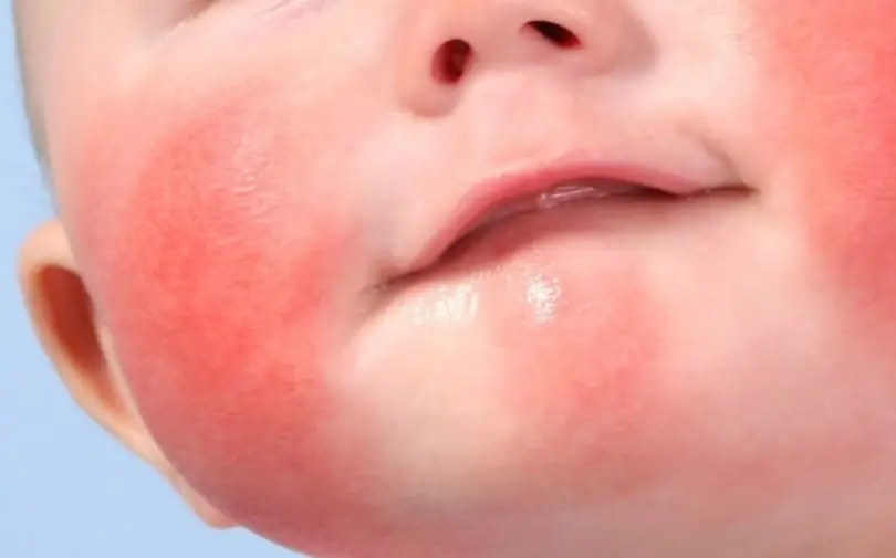 rashes on the body of a child