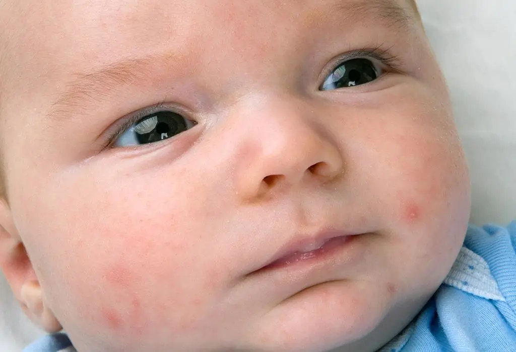 Jerawat pada bayi baru lahir di tubuh: penyebab, diagnosis, dan metode pengobatan. Dermatitis popok pada bayi baru lahir