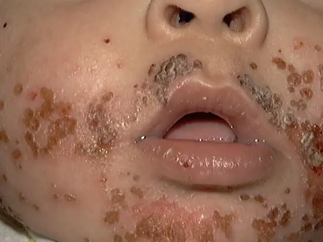 Herpes em crianças photo