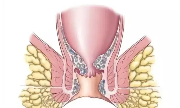 Hemorrhoids sa panahon ng pagbubuntis: sintomas, paggamot at mga kahihinatnan