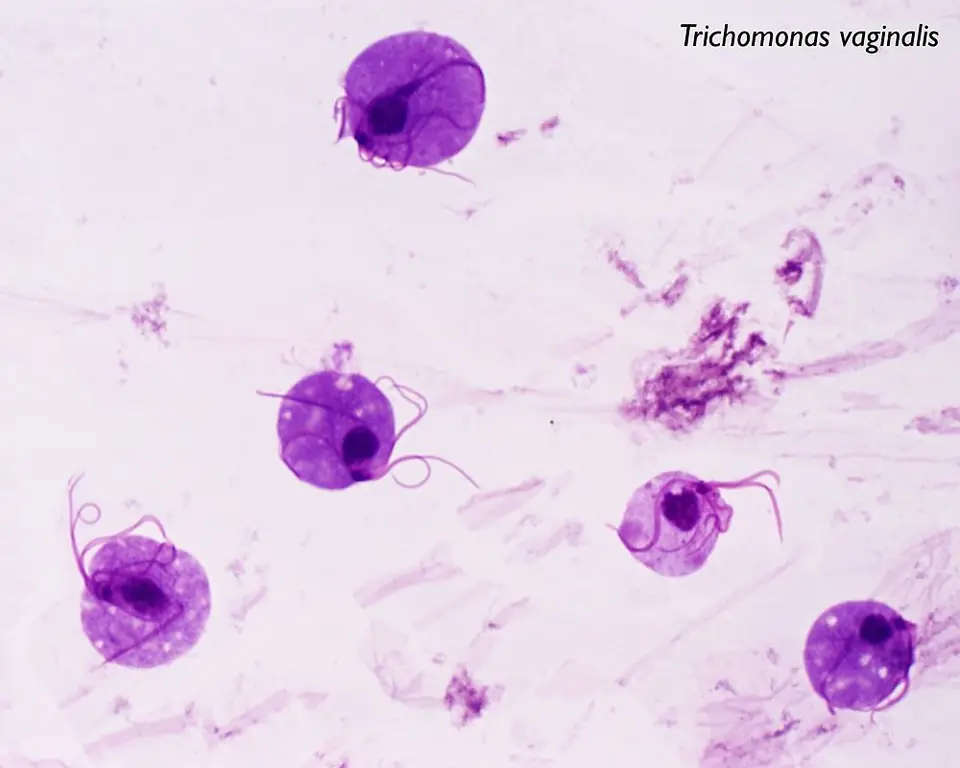 ไตรโคโมแนส วาจินาลิส