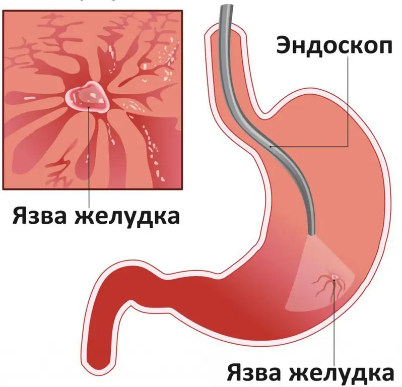 კუჭის წყლული