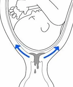 Cum arată un dop de mucus?